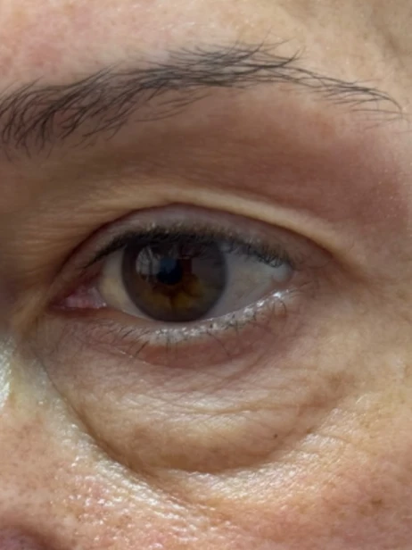 Região dos olhos antes da sessão: bolsa marcada e sulco fundo embaixo do olho.